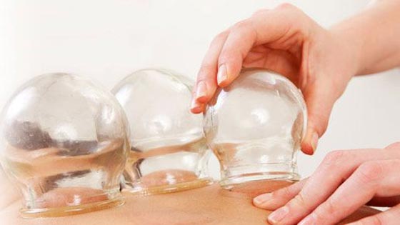 Qu'est-ce que le cupping ?