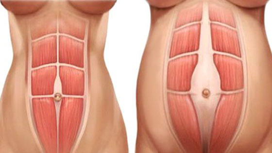 Abdos diastasis